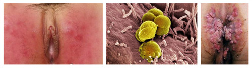 感染上生殖器疱疹的症状是什么